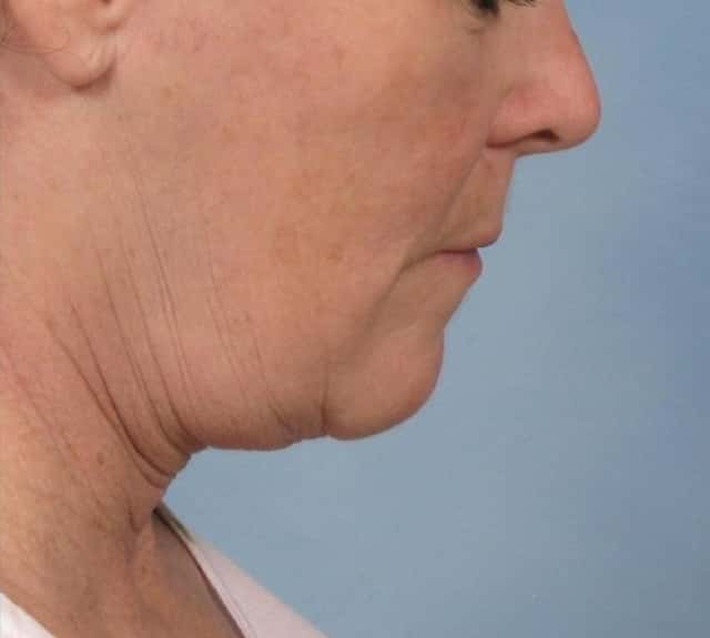 Facelift Before & After Case 109 after