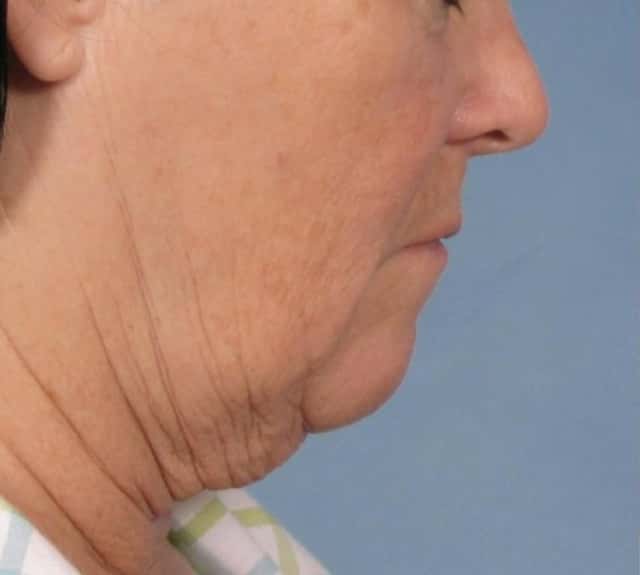 Facelift Before & After Case 109 before