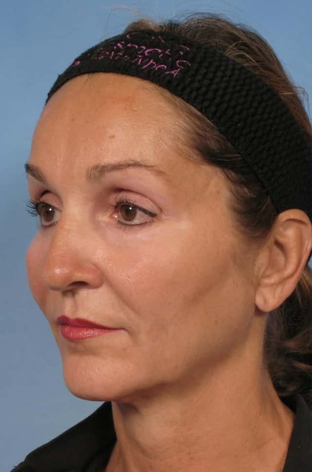Facelift Before & After Case 110 before