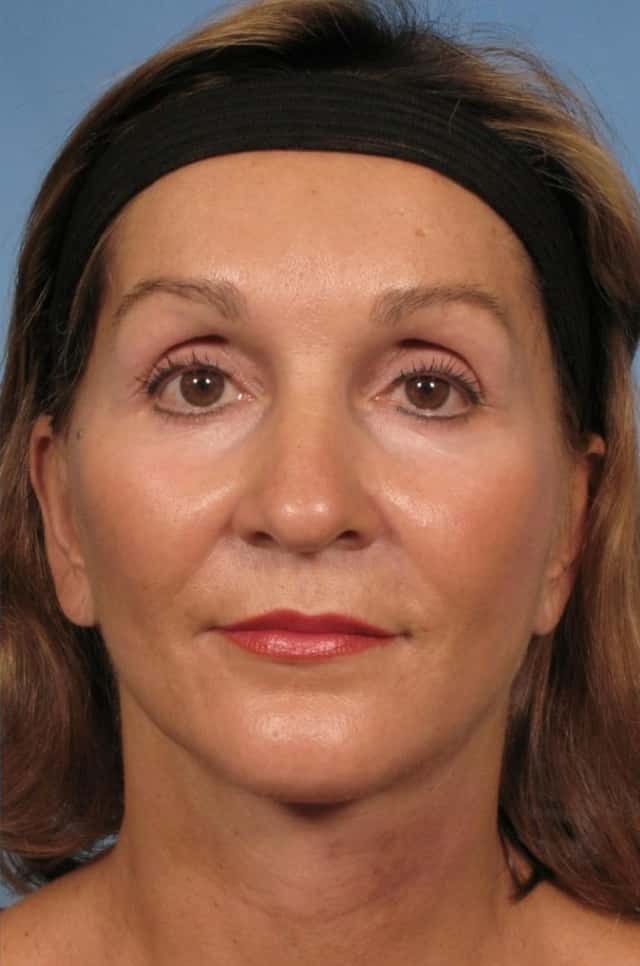 Facelift Before & After Case 110 after
