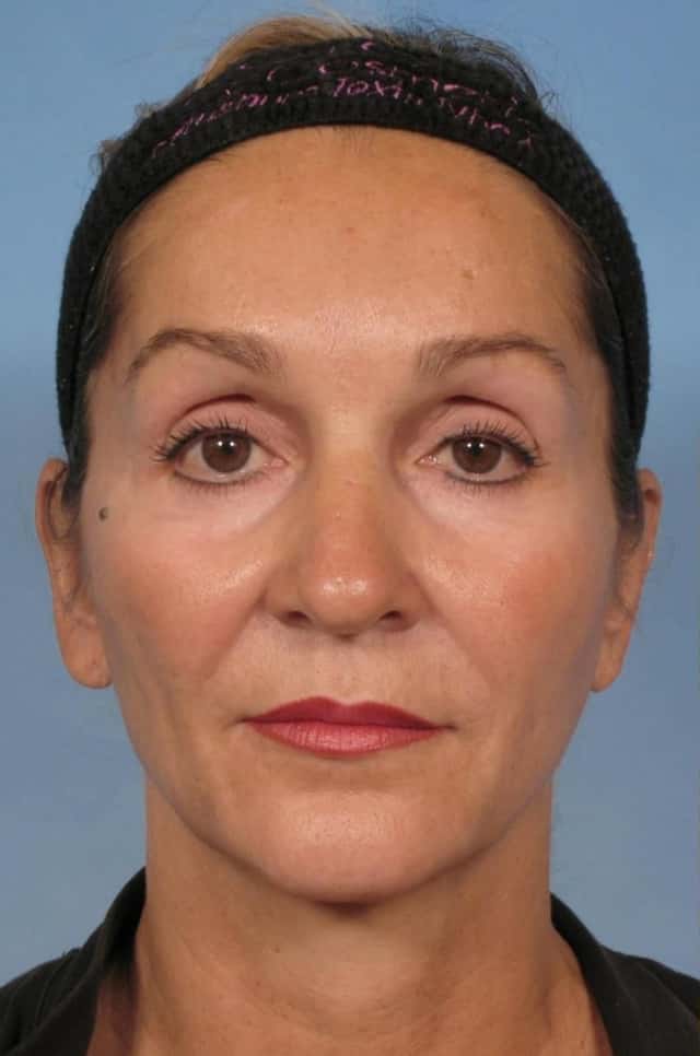 Facelift Before & After Case 110 before