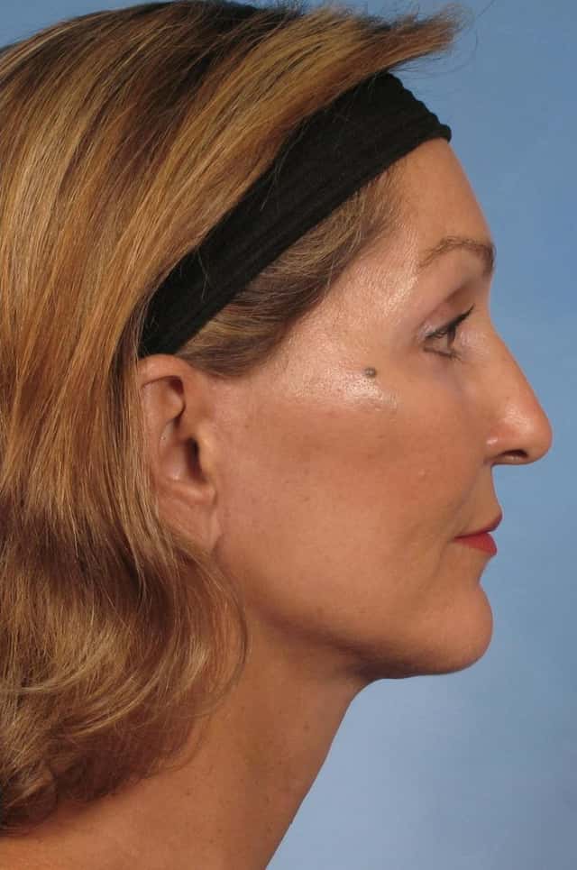 Facelift Before & After Case 110 after