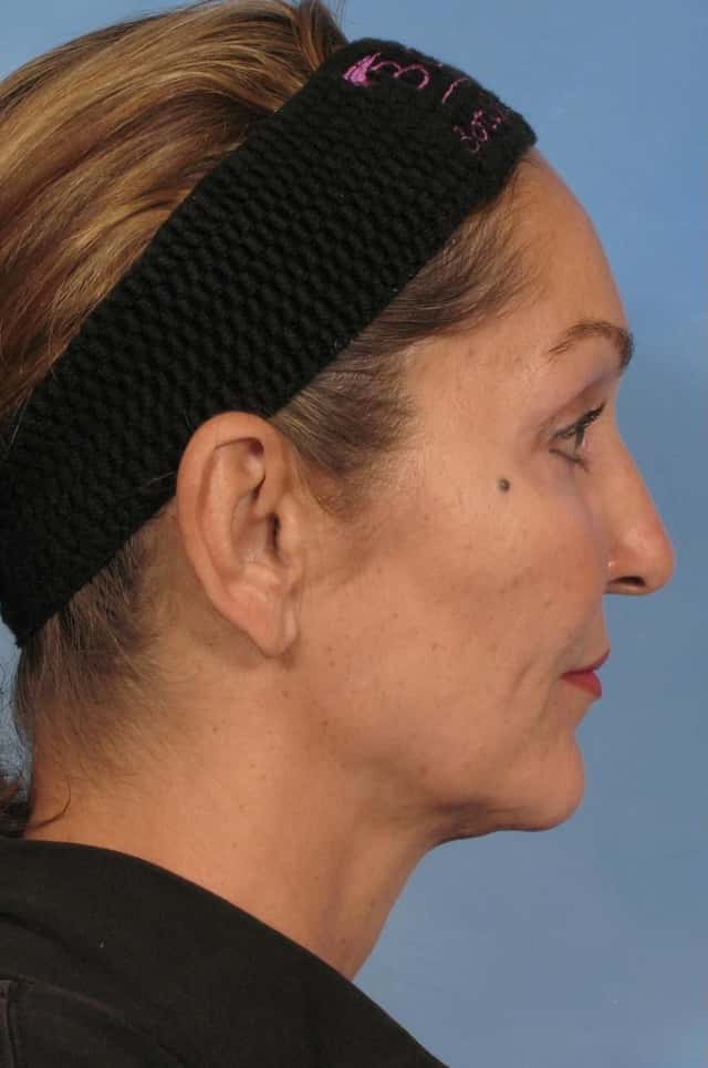 Facelift Before & After Case 110 before
