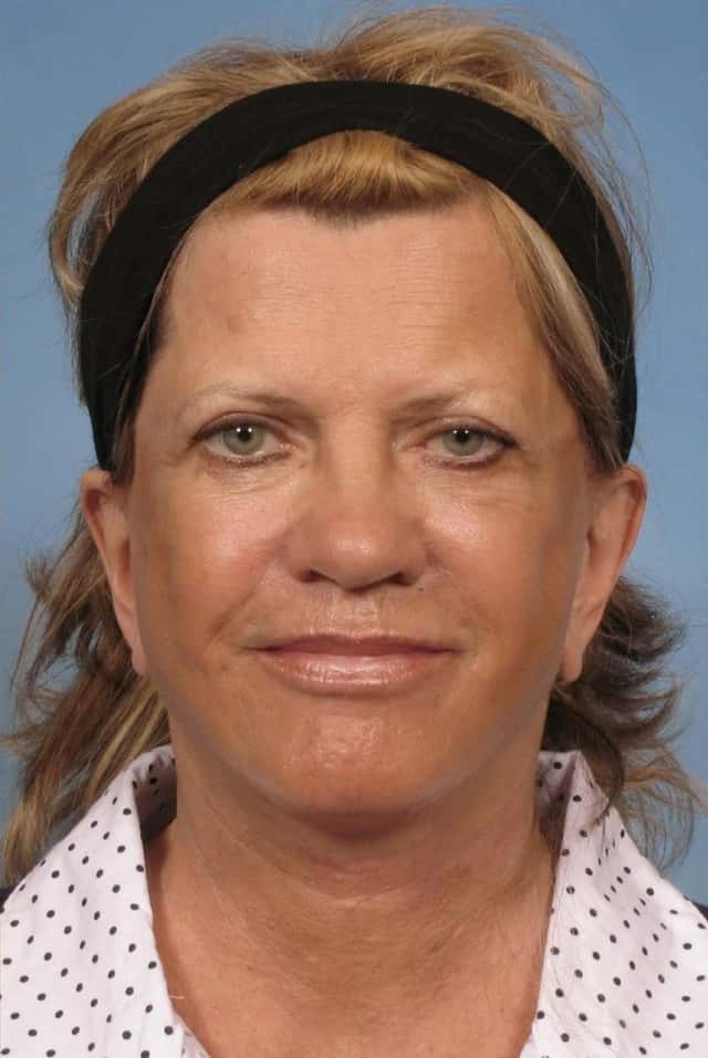 Facelift Before & After Case 111 after