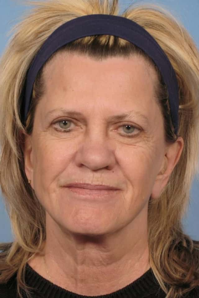 Facelift Before & After Case 111 before