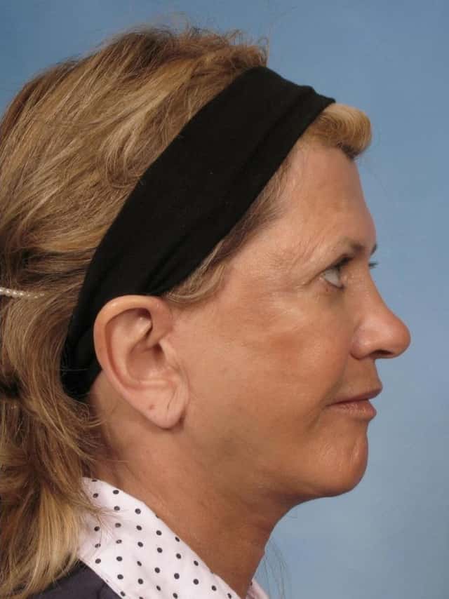 Facelift Before & After Case 111 after