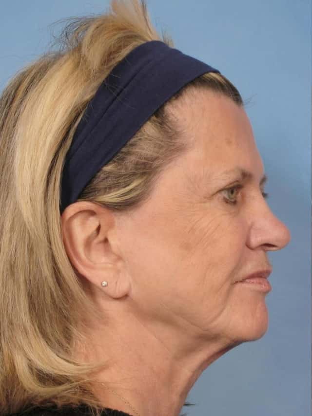 Facelift Before & After Case 111 before