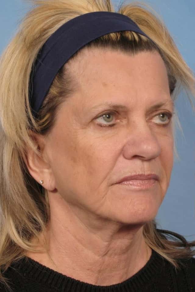 Facelift Before & After Case 111 before