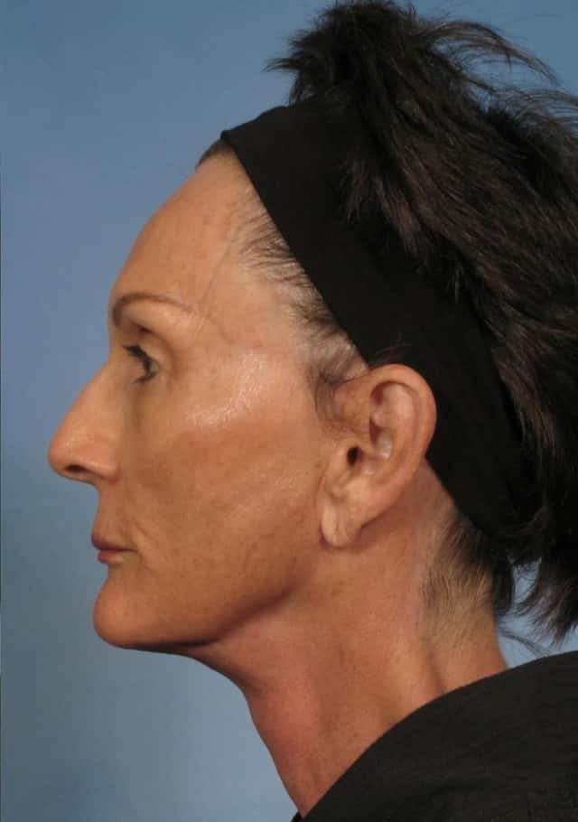 Facelift Before & After Case 142 after
