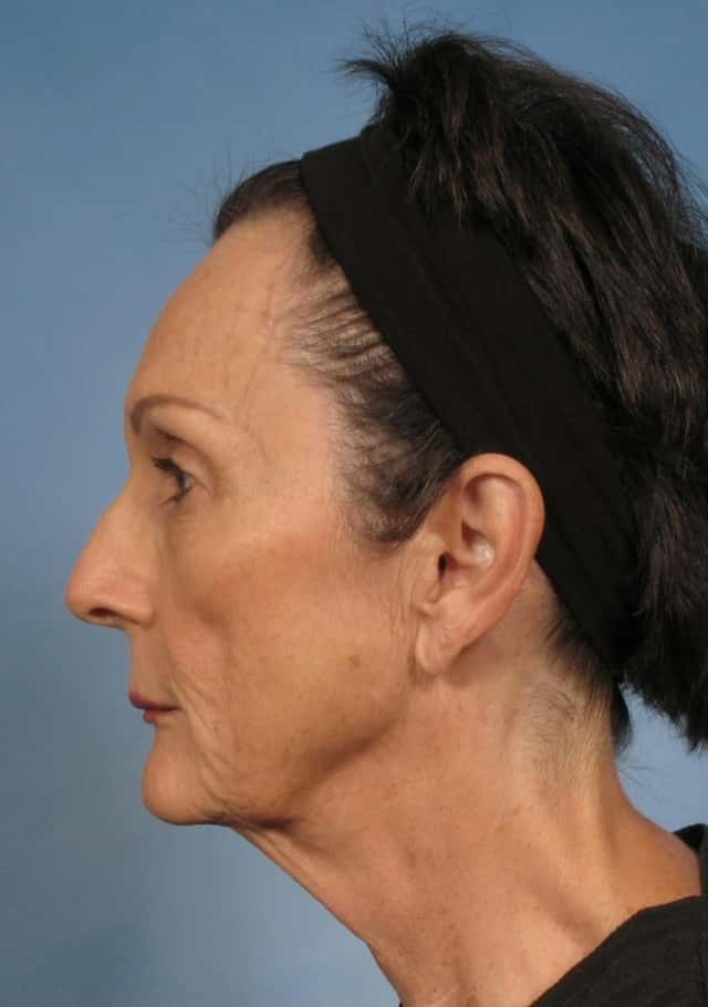 Facelift Before & After Case 142 before