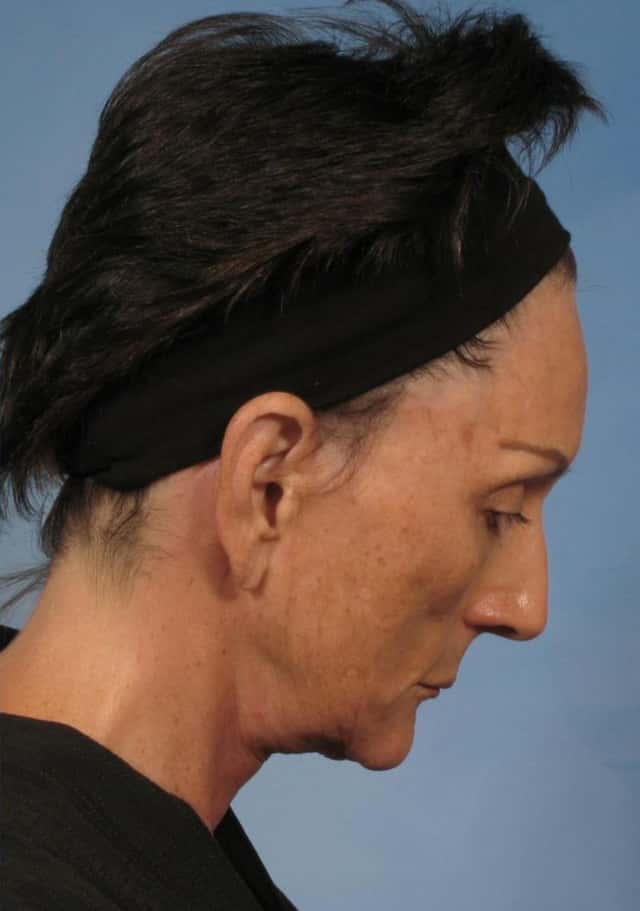Facelift Before & After Case 142 after