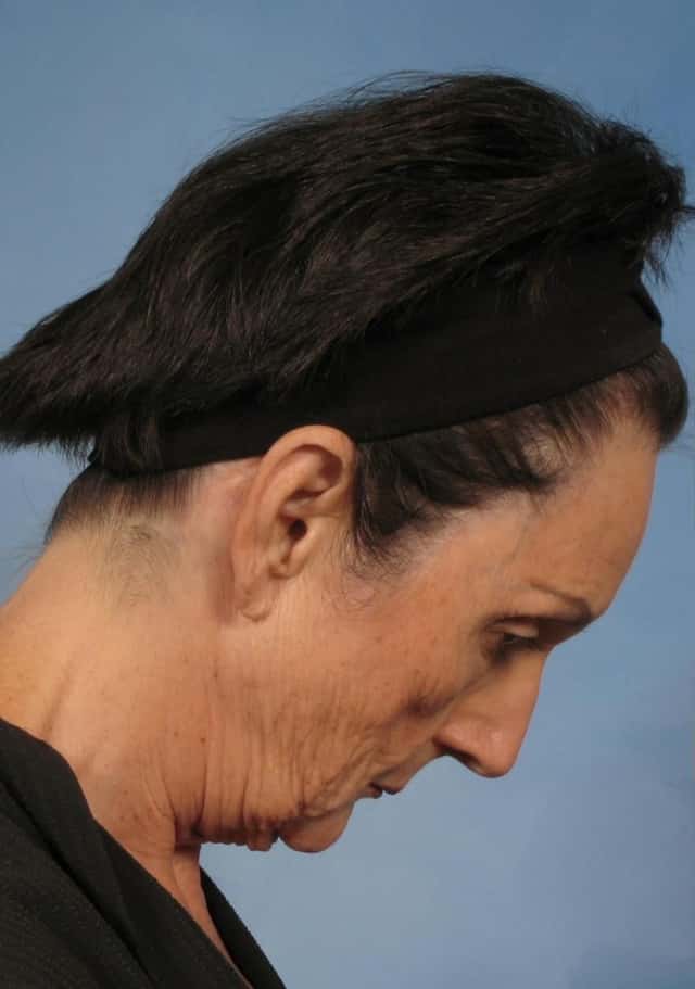 Facelift Before & After Case 142 before