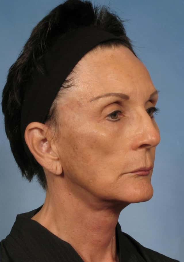Facelift Before & After Case 142 after