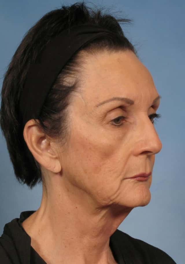 Facelift Before & After Case 142 before