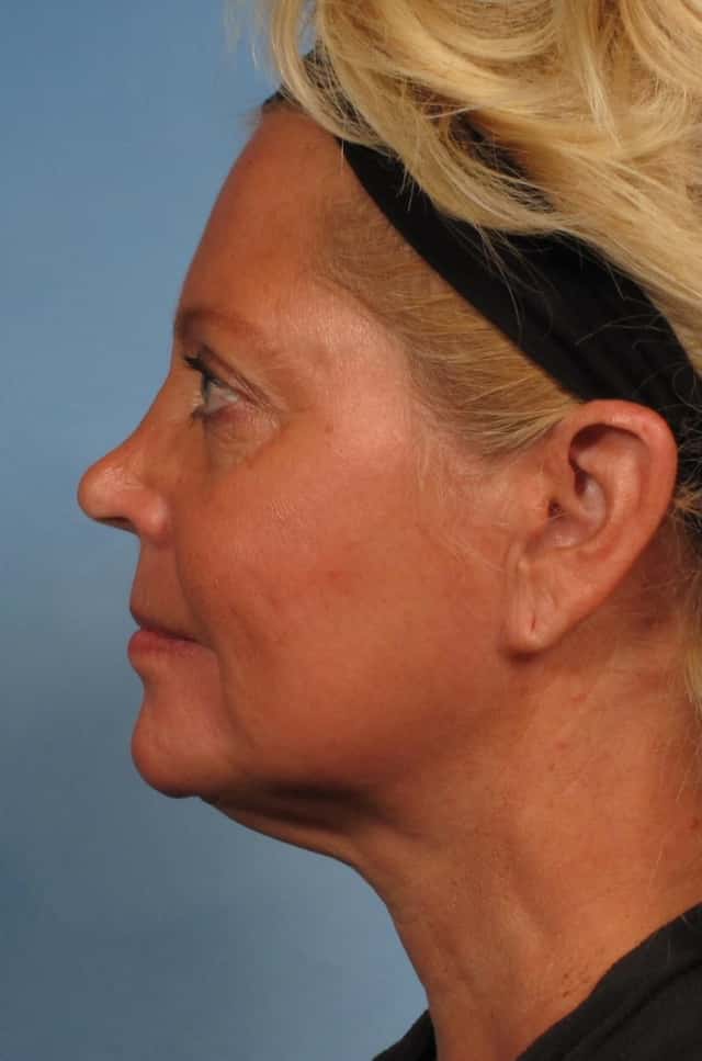 Facelift Before & After Case 166 before