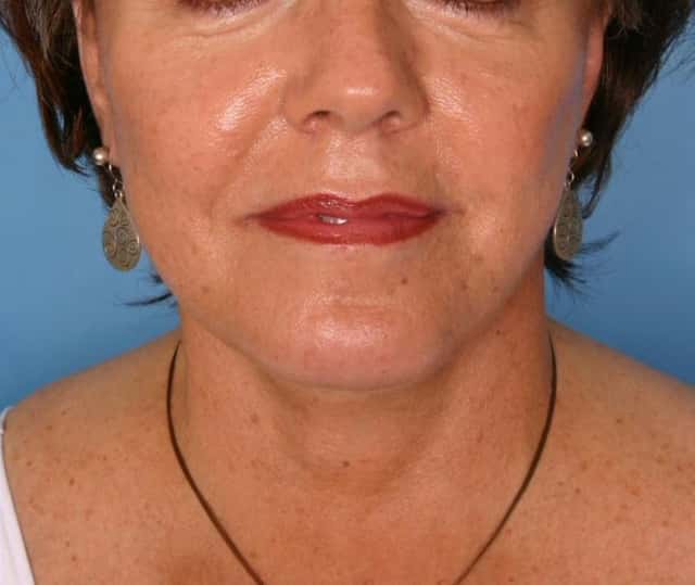 Facelift Before & After Case 179 after