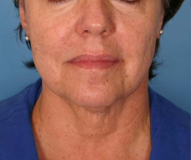 Facelift Before & After Case 179 before