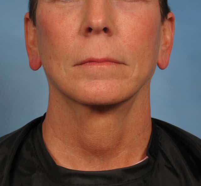 Facelift Before & After Case 180 after