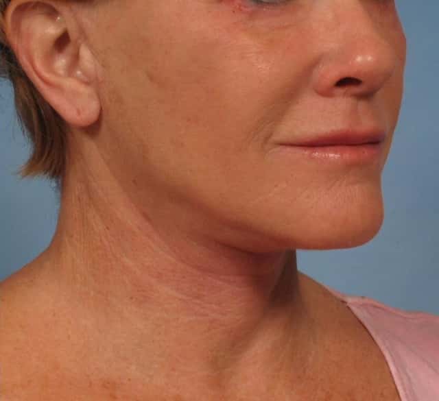 Facelift Before & After Case 181 after