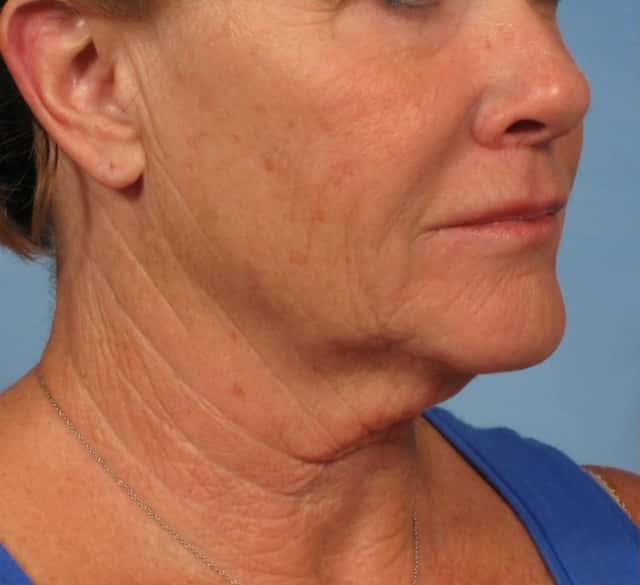 Facelift Before & After Case 181 before