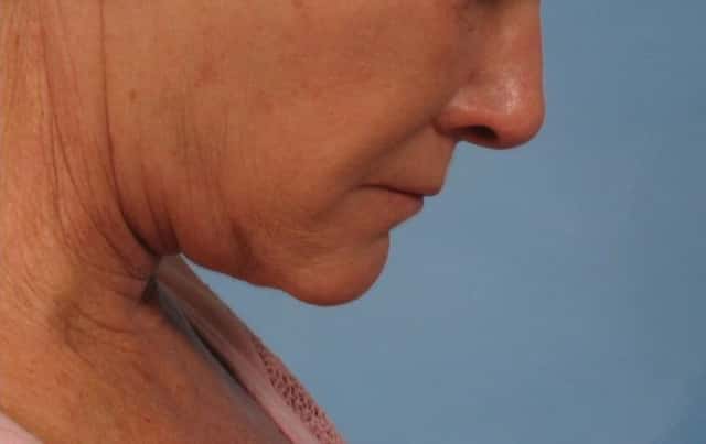 Facelift Before & After Case 181 after