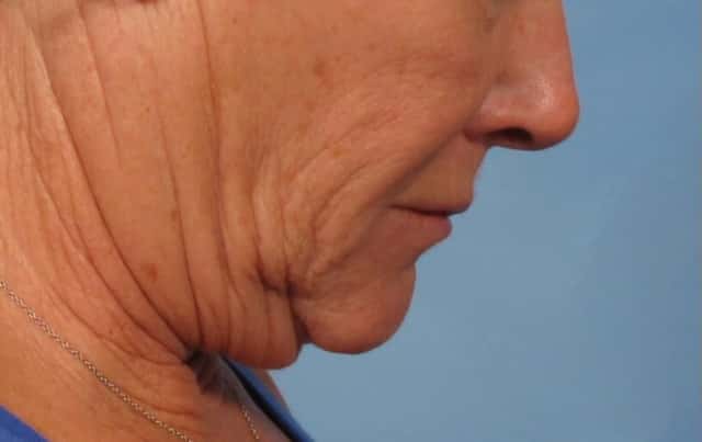 Facelift Before & After Case 181 before