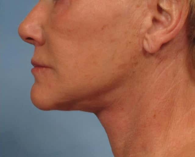Facelift Before & After Case 181 after