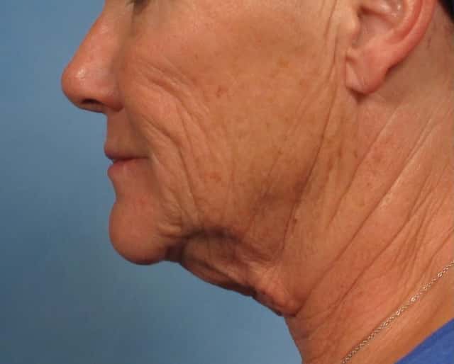 Facelift Before & After Case 181 before