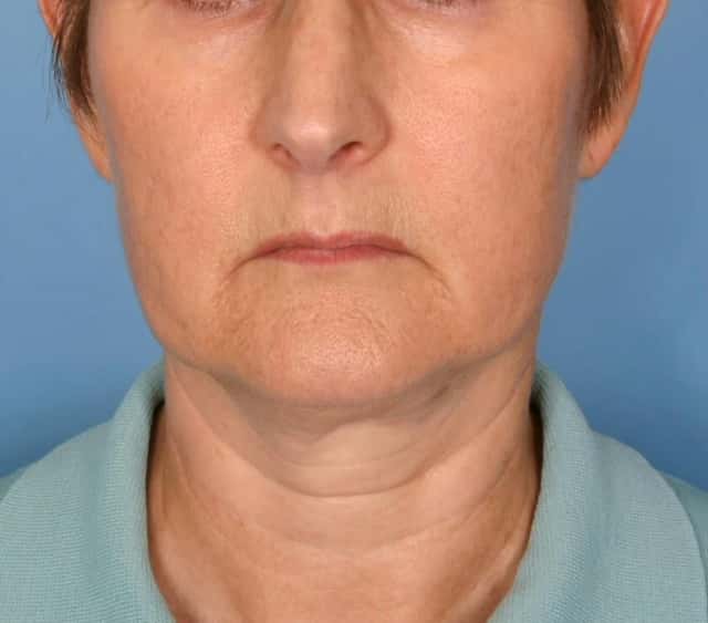 Facelift Before & After Case 182 before