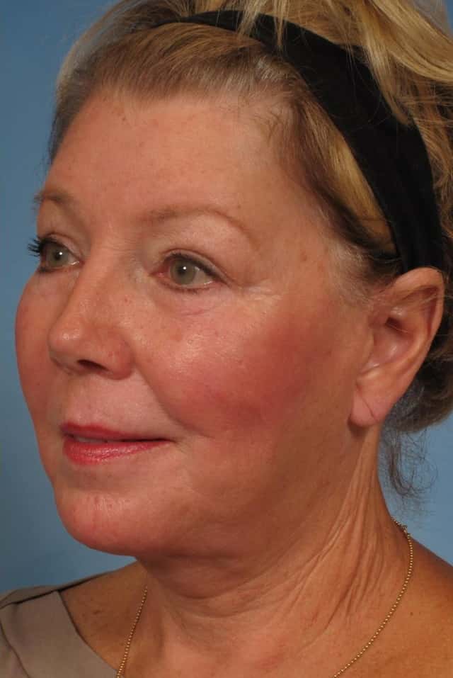 Facelift Before & After Case 183 after