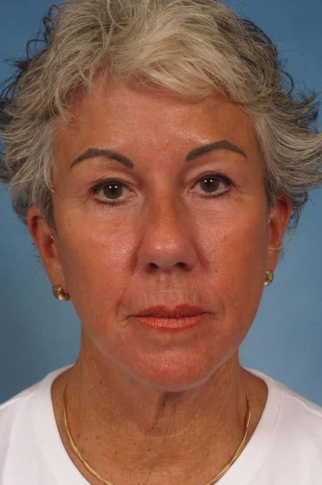 Facelift Before & After Case 185 after