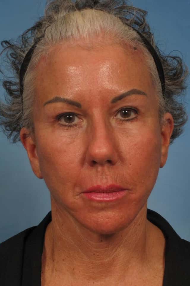 Facelift Before & After Case 185 after