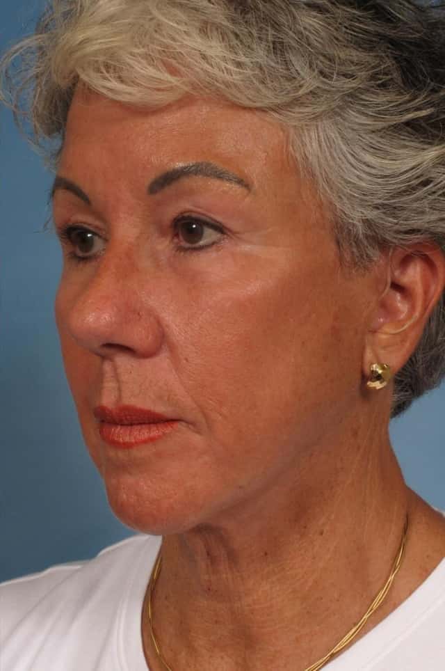 Facelift Before & After Case 185 after