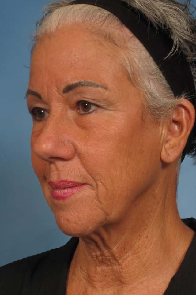 Facelift Before & After Case 185 before