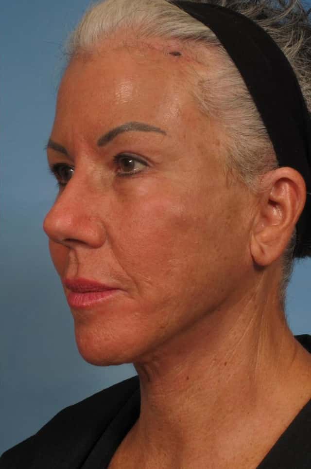 Facelift Before & After Case 185 after