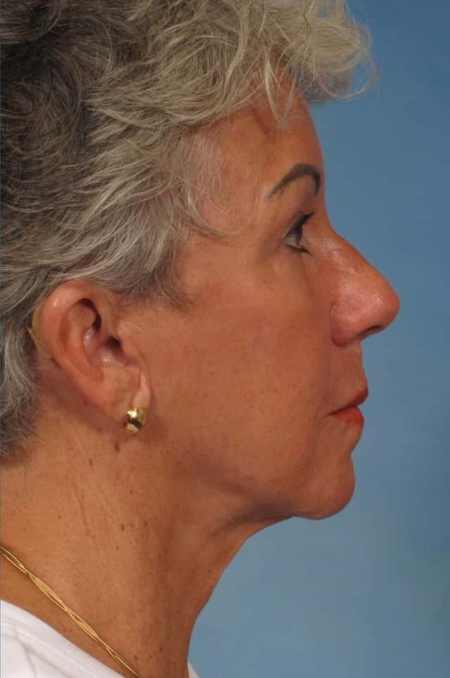 Facelift Before & After Case 185 after
