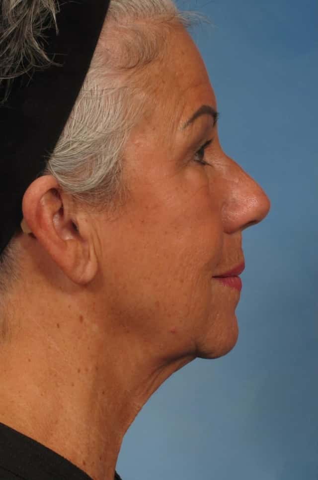 Facelift Before & After Case 185 before