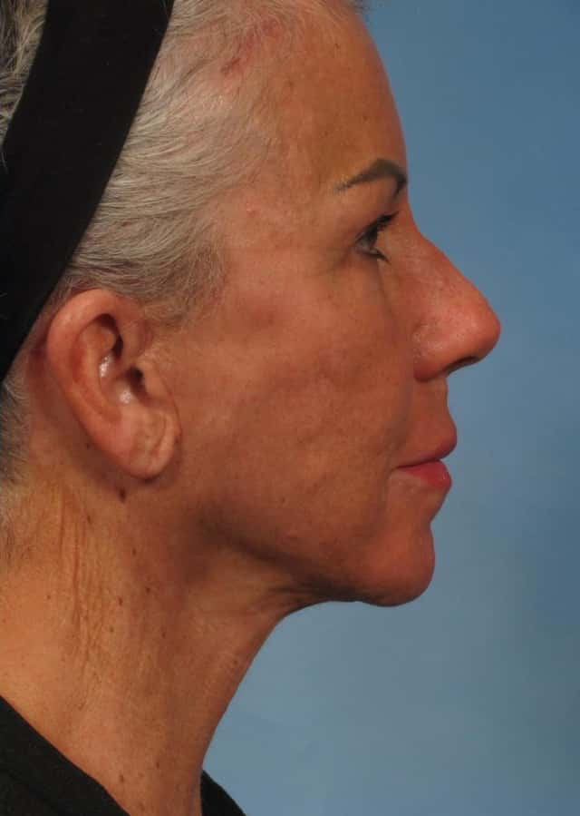Facelift Before & After Case 185 after