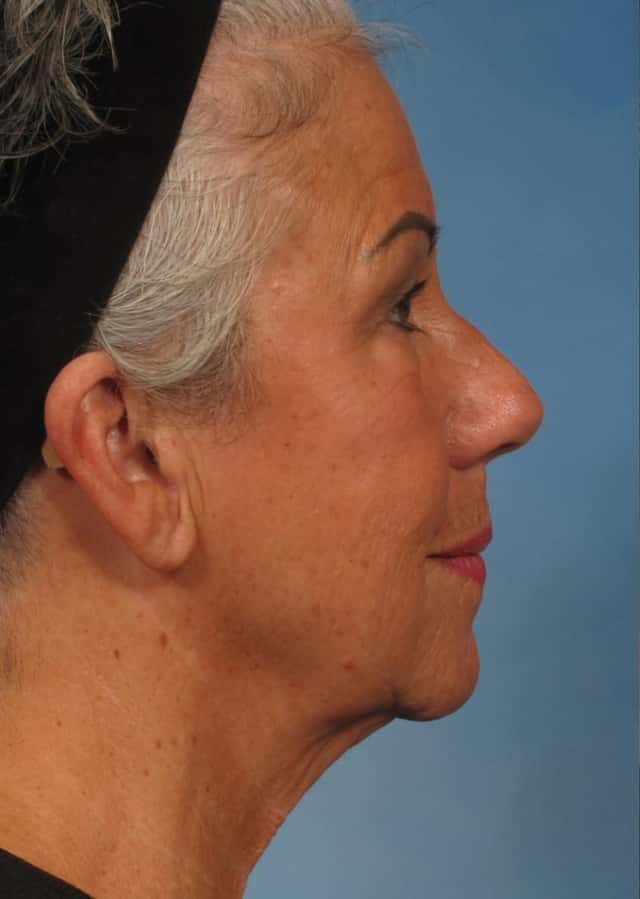 Facelift Before & After Case 185 before