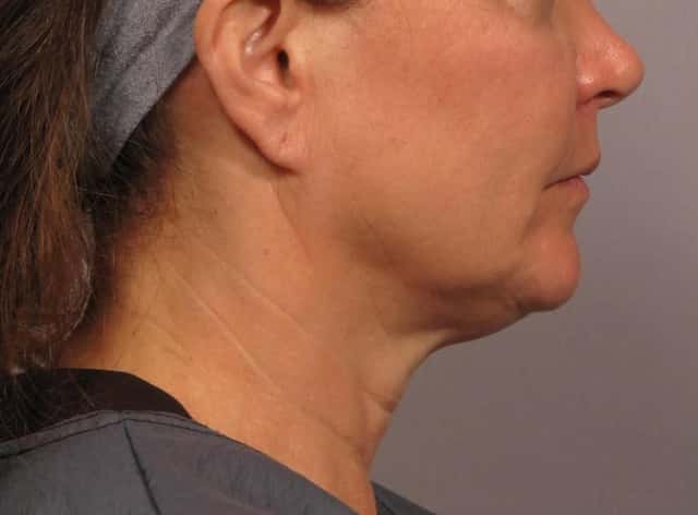 Facelift Before & After Case 300 before