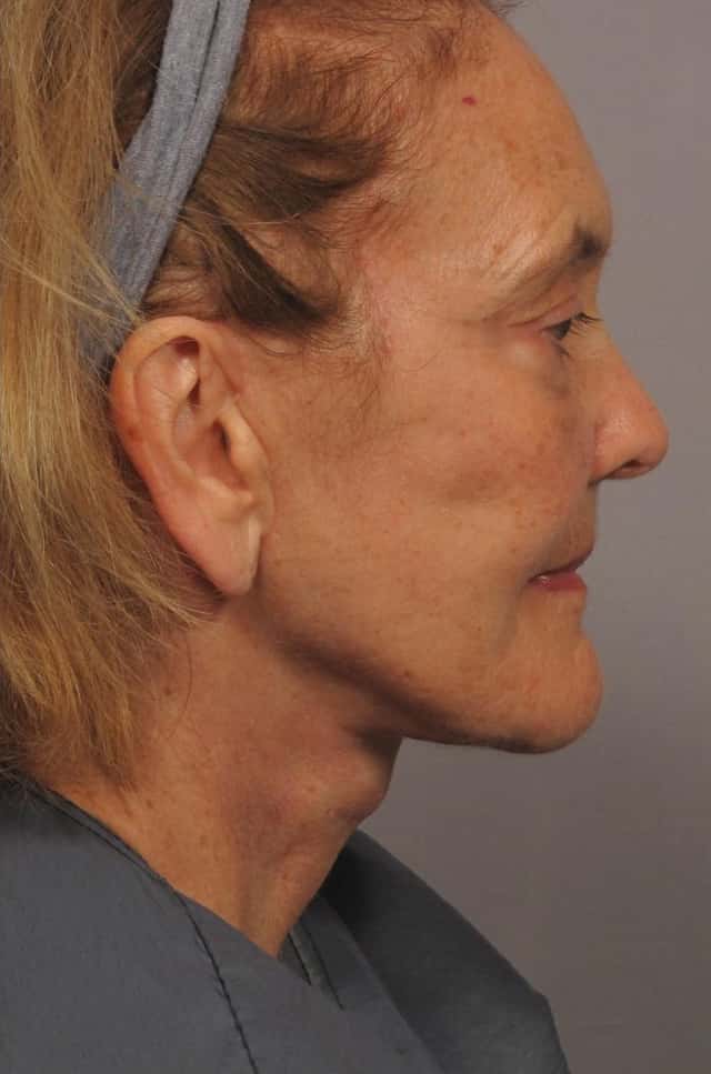 Facelift Before & After Case 306 after