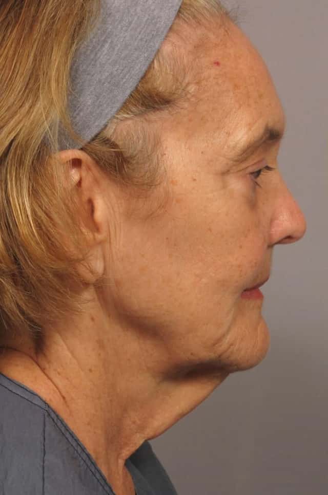 Facelift Before & After Case 306 before