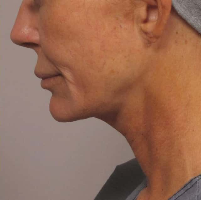 Woman undergoes Facelift with fat grafting and central face peel in Naples, Florida with Dr. Hasen after