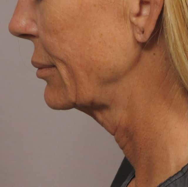 Woman undergoes Facelift with fat grafting and central face peel in Naples, Florida with Dr. Hasen before