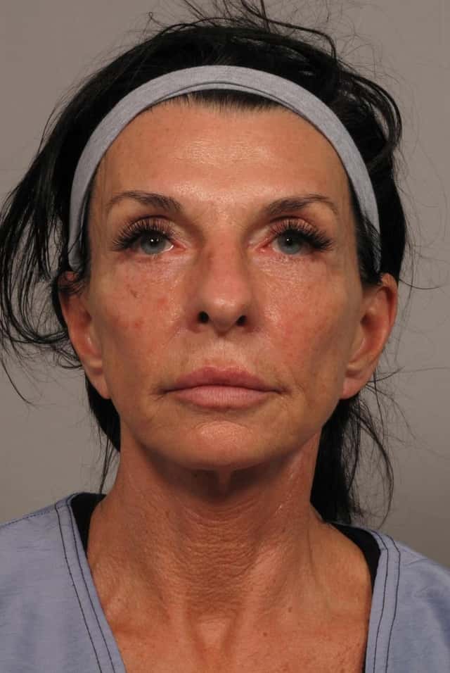 1 year post-op frontal photo of facelift patient in Naples, Florida by Dr. Kent Hasen