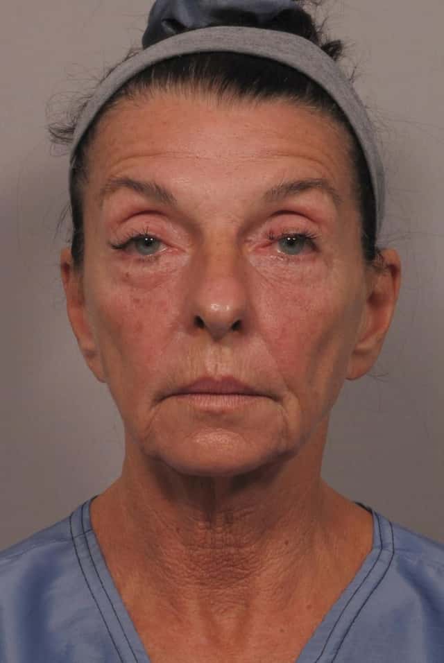 Pre-op frontal photo of facelift patient in Naples, Florida by Dr. Kent Hasen