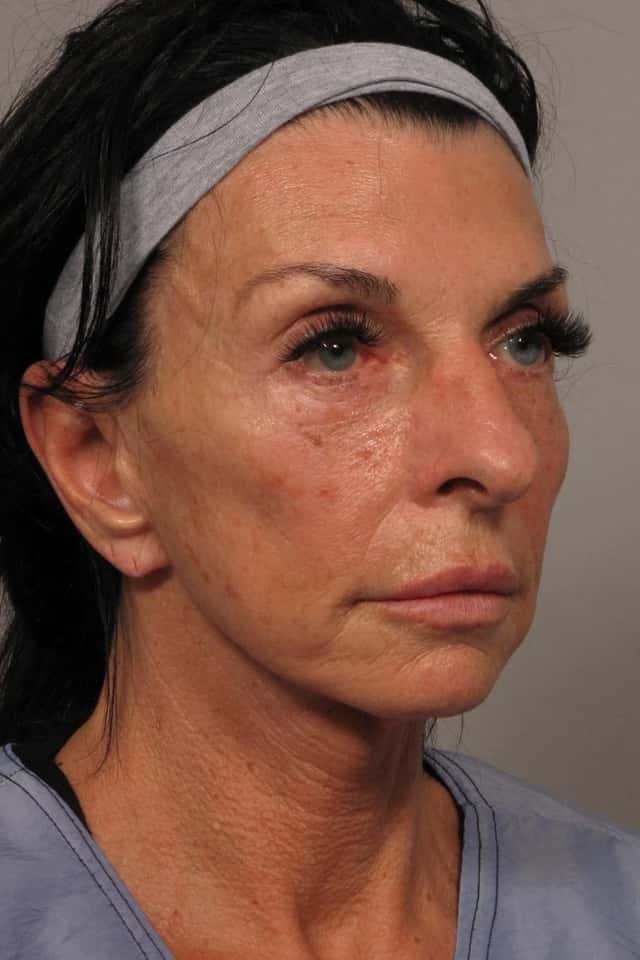 1 year post-op Right Oblique photo of facelift patient in Naples, Florida by Dr. Kent Hasen