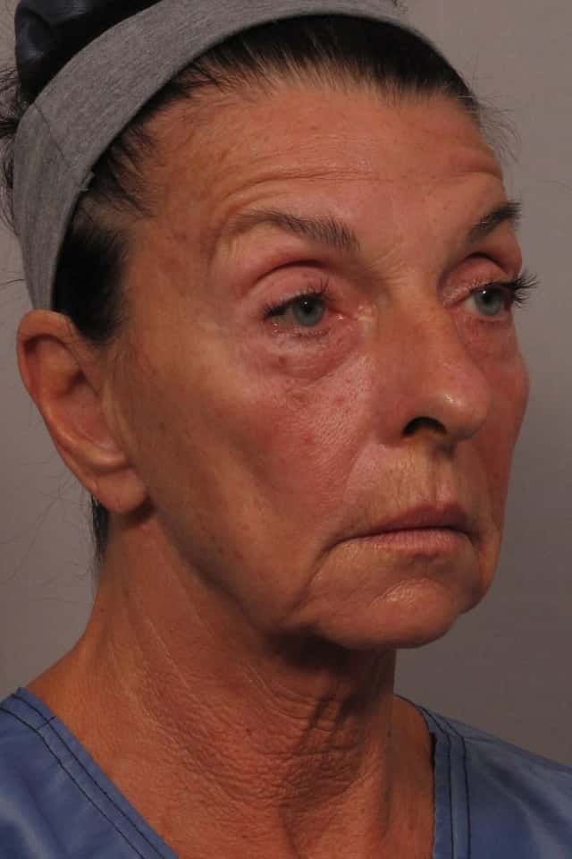 Pre-op Right Oblique photo of facelift patient in Naples, Florida by Dr. Kent Hasen