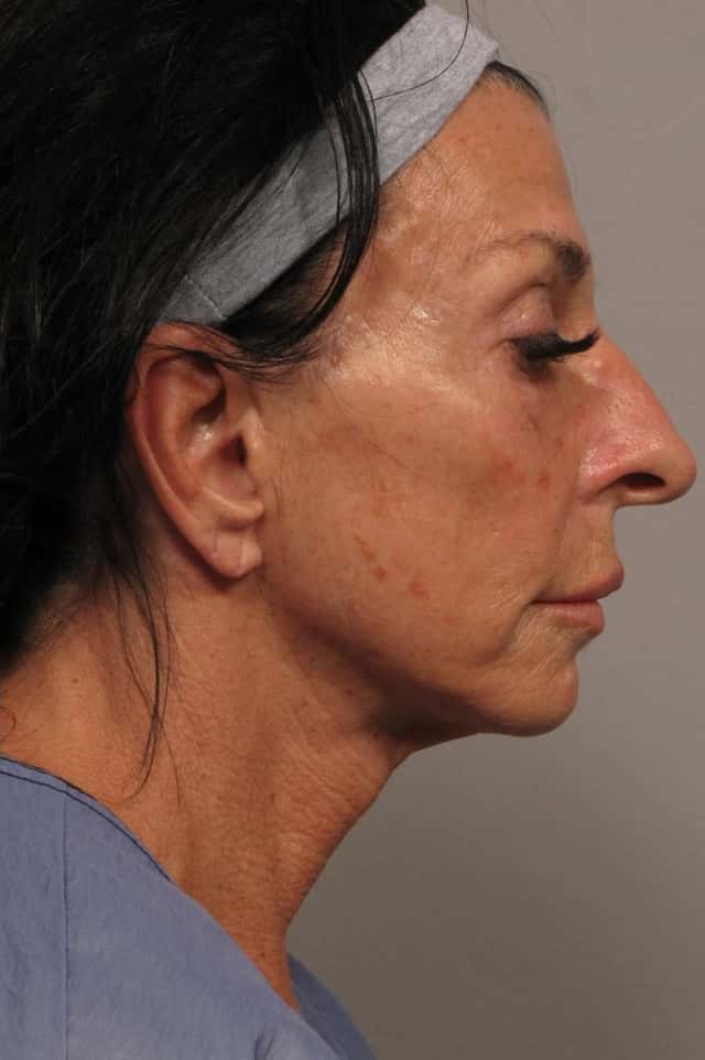 Right side 1 year post-op photo of Facelift in Naples, Florida by Dr. Kent Hasen