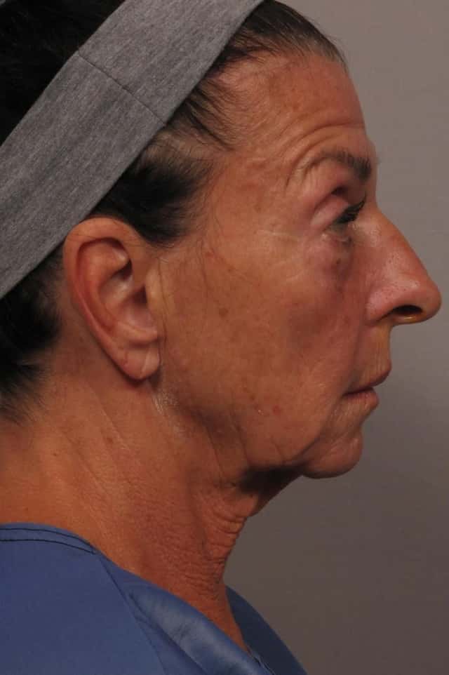 Right side pre-op photo of Facelift in Naples, Florida by Dr. Kent Hasen